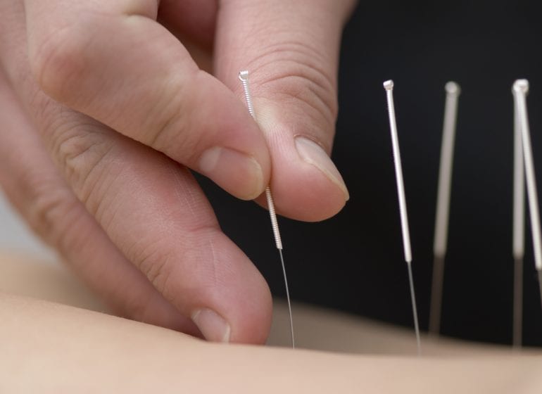 Acupuncture