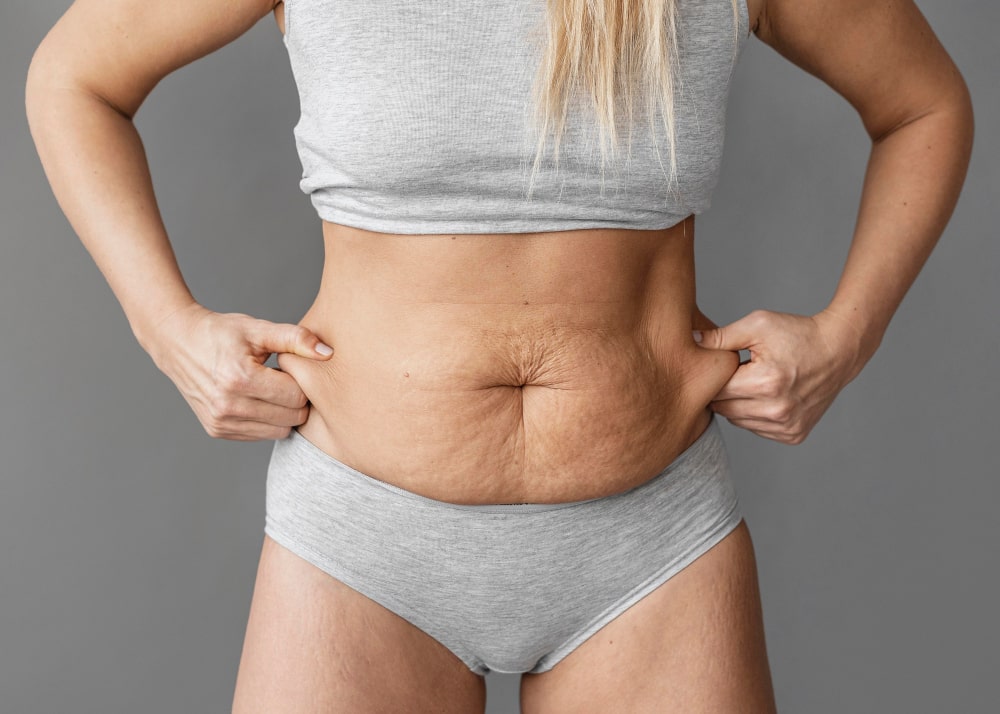 abdominoplastie